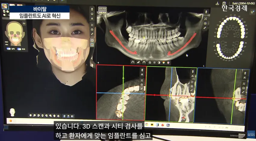 임플란트도 AI가 대세!!  **이제 수술 하루 만에 끝낸다**