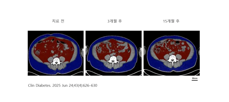 IMG_2413.webp 마운자로 맞으면 살이 어떻게 빠지는지 추적 조사한 결과 ㄷㄷ