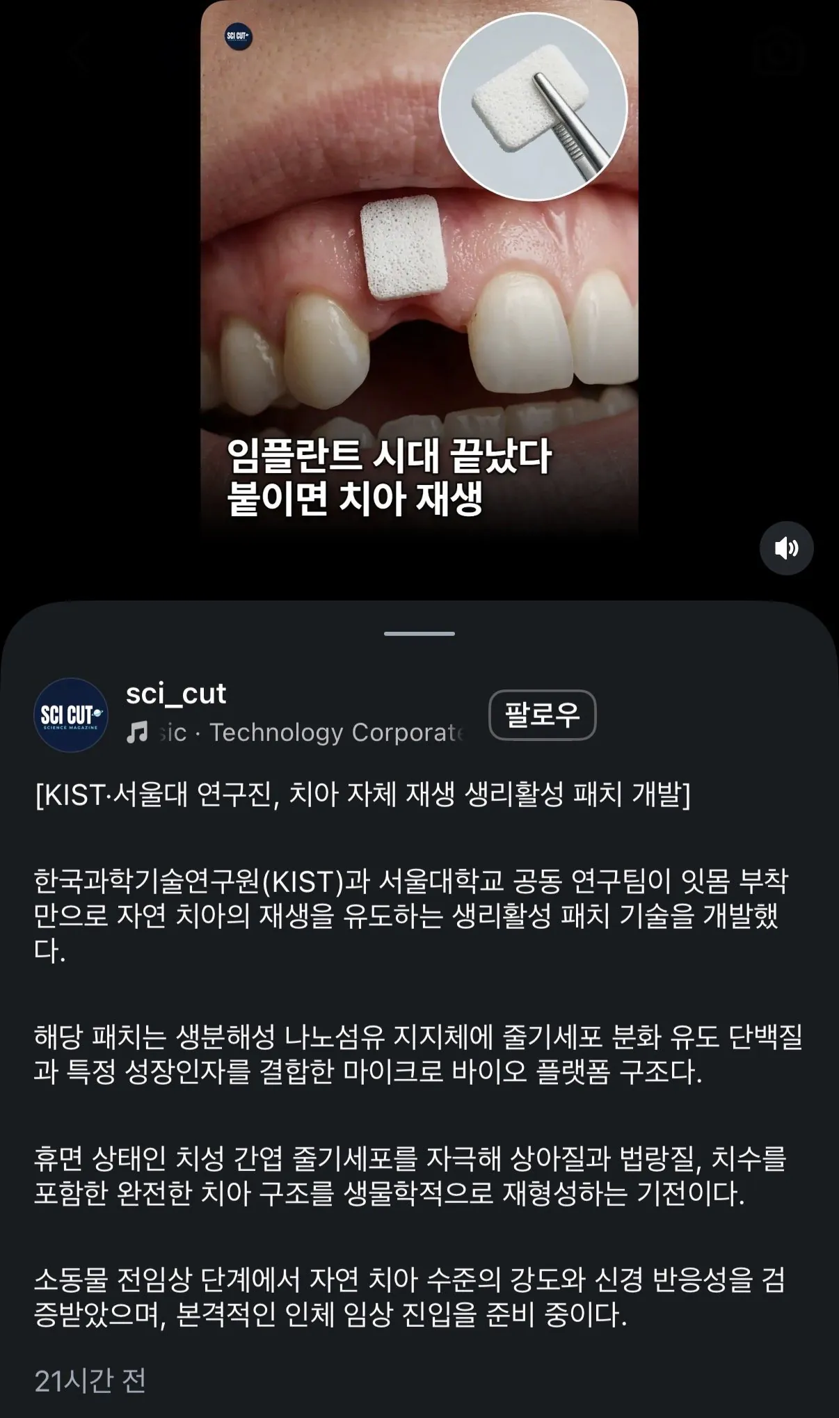 IMG_9227.jpeg 이제 임플란트 필요없는 시대가 온다함