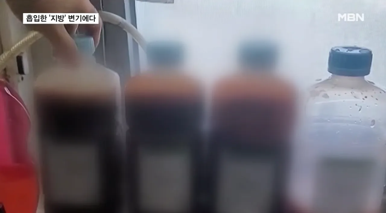 흡입한 지방 변기에 '콸콸'…불법 성형외과 무더기 적발 (5).png 지방흡입으로 빼낸 지방을 하수구 . 변기에 버린 병원들