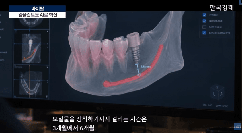 임플란트도 AI가 대세!!  **이제 수술 하루 만에 끝낸다**