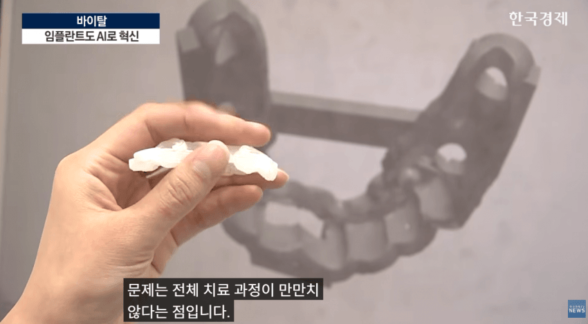 임플란트도 AI가 대세!!  **이제 수술 하루 만에 끝낸다**