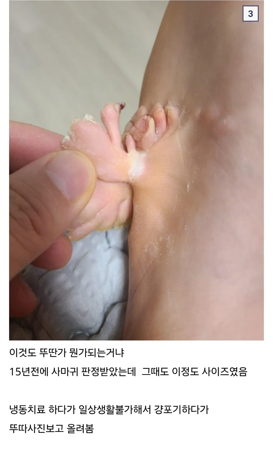 19febd29c16560b4a.webp 약혐) 티눈갤 형님들 ㄷㄷㄷ.jpg