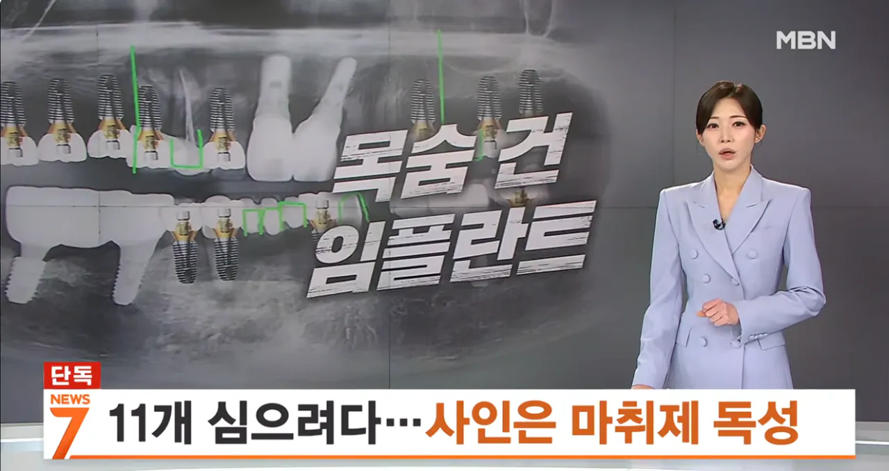 [단독] 임플란트 11개 하루에 심으려다 사망…국과수 마취제 독성 때문 (1).png [단독] 임플란트 11개 하루에 심으려다 사망 국과수 마취제 독성 때문