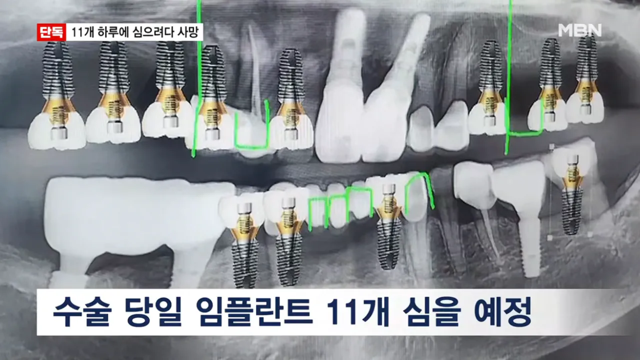 [단독] 임플란트 11개 하루에 심으려다 사망…국과수 마취제 독성 때문 (8).png [단독] 임플란트 11개 하루에 심으려다 사망 국과수 마취제 독성 때문