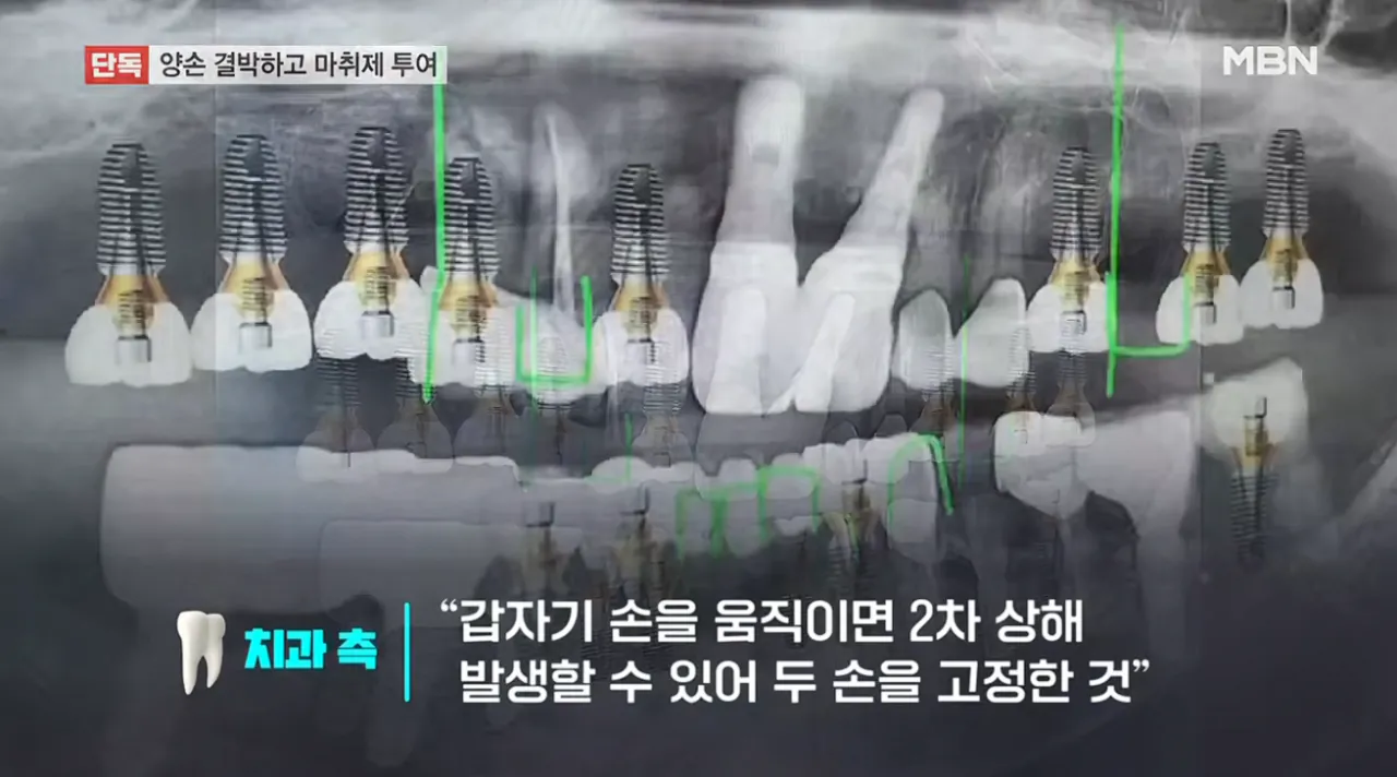 [단독] 임플란트 사망 사고 영상 봤더니…손목 결박 후 마취제 투여 (14).png [단독] 임플란트 사망 CCTV 봤더니 손목 결박 후 마취제 투여