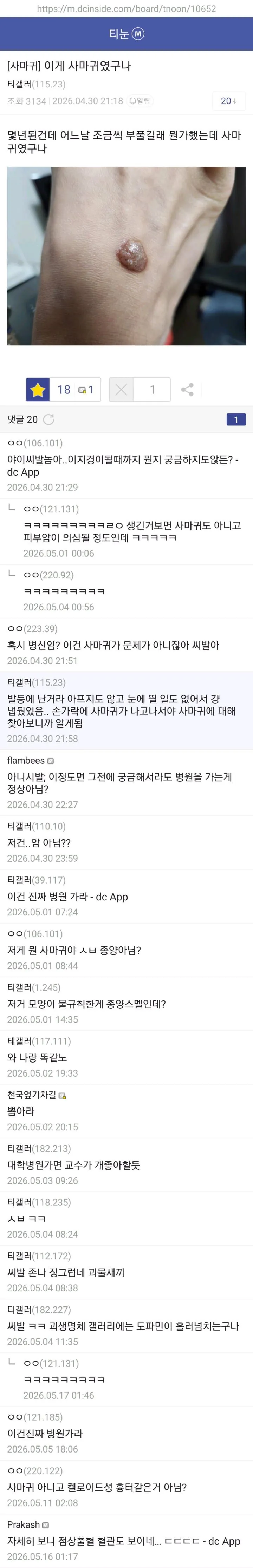 b5c23214290280780444e96cc12479cd.jpg 약혐) 티눈갤 형님들 ㄷㄷㄷ.jpg