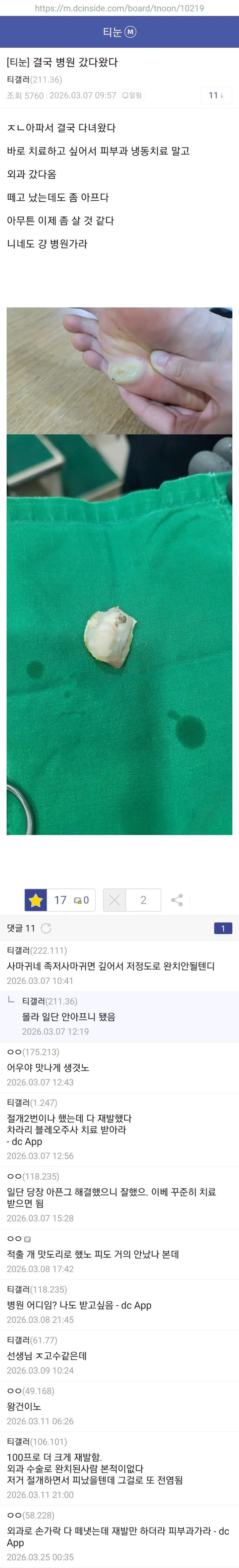 93cd23fb289ab652ddb1c3cf1d0141da.jpg 약혐) 티눈갤 형님들 ㄷㄷㄷ.jpg