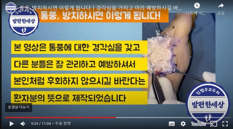 18a280be1d951b2bd.jpg [극혐] 몸에서 탕수육을 생산하는 통풍환자 수술