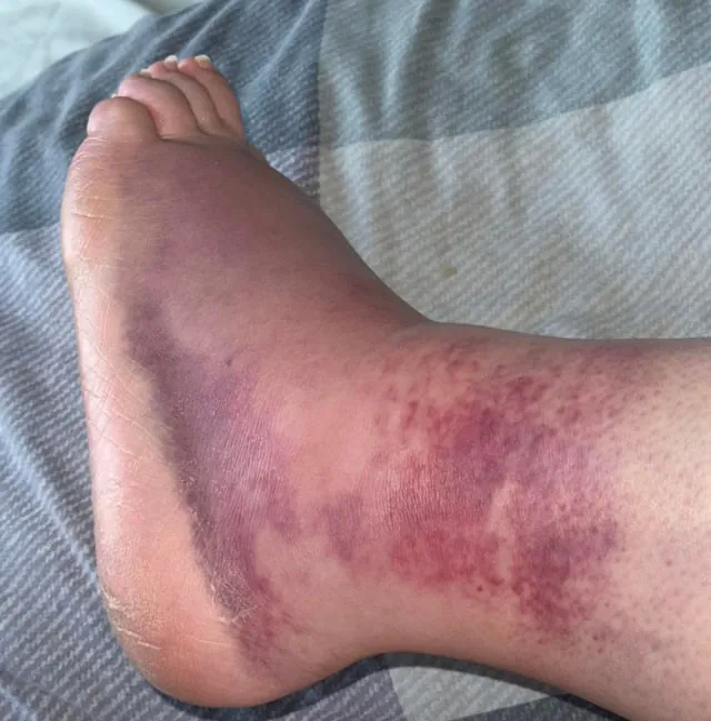 potential-grade-3-ankle-sprain-v0-1hh57n89f05g1.jpg 혐주의?))) 3도 염좌로 추정될때의 발 상태 ㄷㄷㄷㄷㄷ
